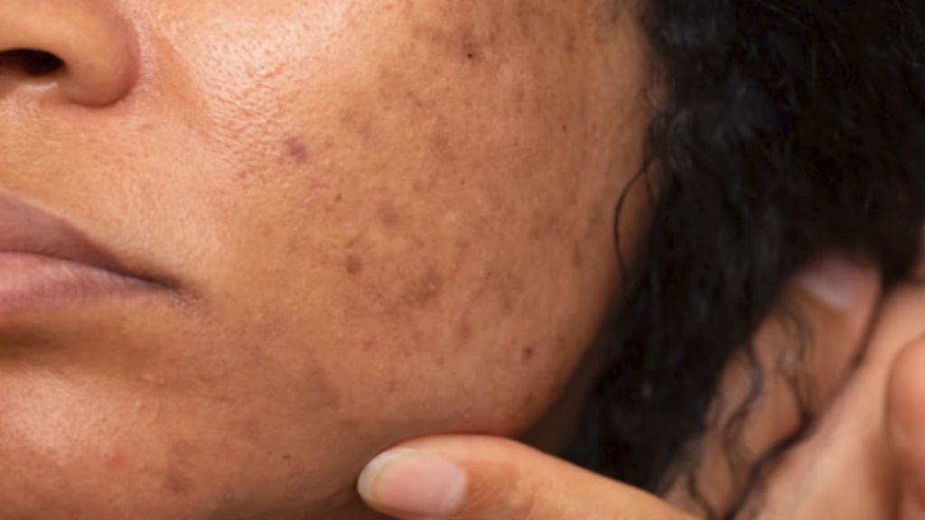 Dark Spots on face skin